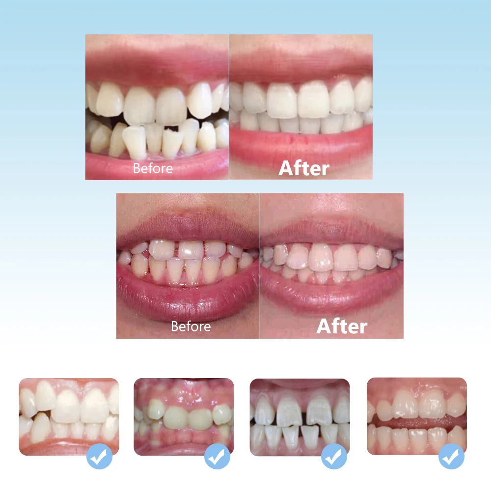3-Stage Kids Dental Orthodontic Alignment Trainer and Retainer Set
