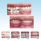 3-Stage Kids Dental Orthodontic Alignment Trainer and Retainer Set