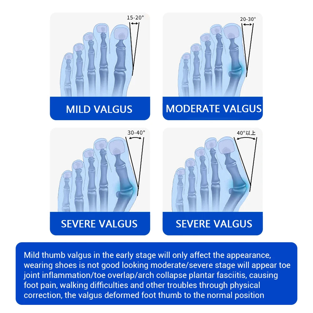 Adjustable Bunion Corrector for Hallux Valgus Support - 5