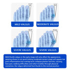 Adjustable Bunion Corrector for Hallux Valgus Support