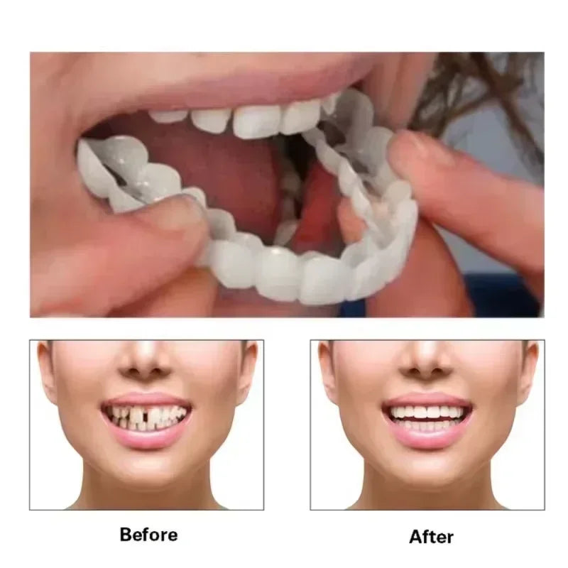 Snap-On Temporary Cosmetic Teeth Veneer Kit
