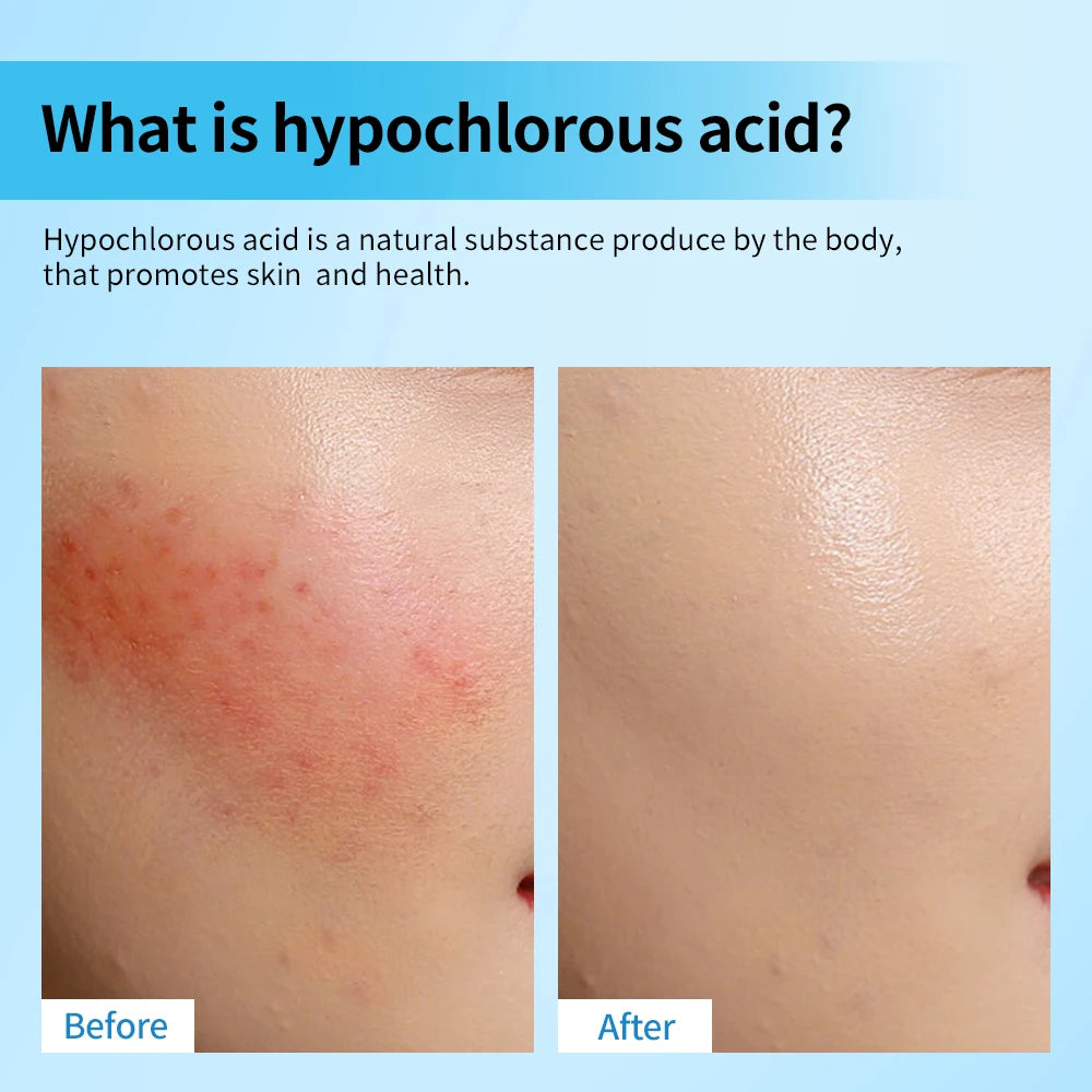 Hypochlorous Acid Facial Spray for Acne and Sensitive Skin