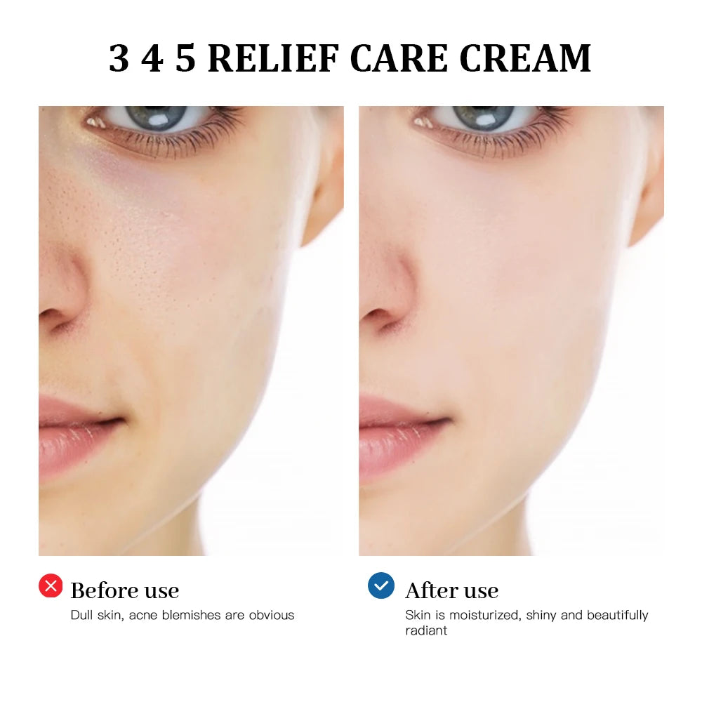 345 Relief Facial Cream for Blemish and Acne Prone Skin - 3