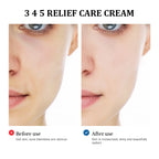 345 Relief Facial Cream for Blemish and Acne Prone Skin