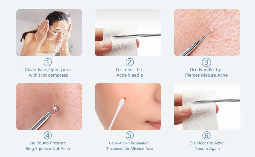 Stainless Steel Blackhead and Pimple Extractor Kit