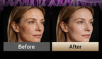 LED Facial and Body Sculpting Beauty Device