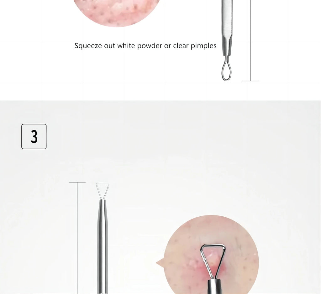 Stainless Steel Blackhead and Pimple Extractor Kit