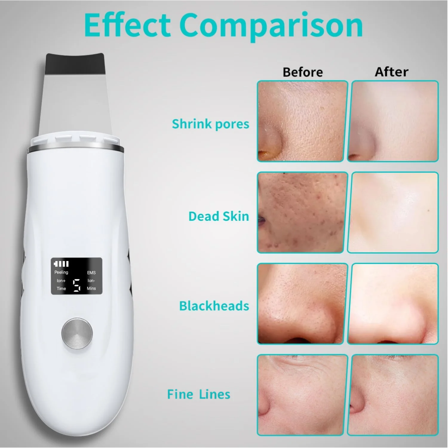 Ultrasonic Facial Skin Scrubber and Pore Cleanser - 3
