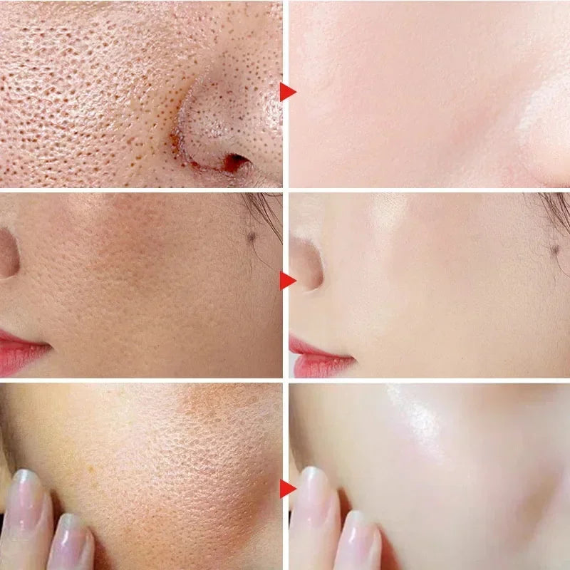 Salicylic Acid Pore Refining Cream for Acne and Blackheads