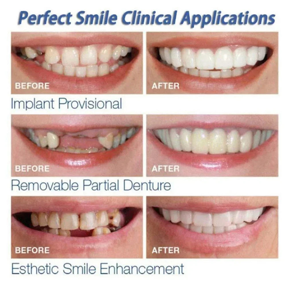 Snap-On Temporary Cosmetic Teeth Veneer Kit - 9
