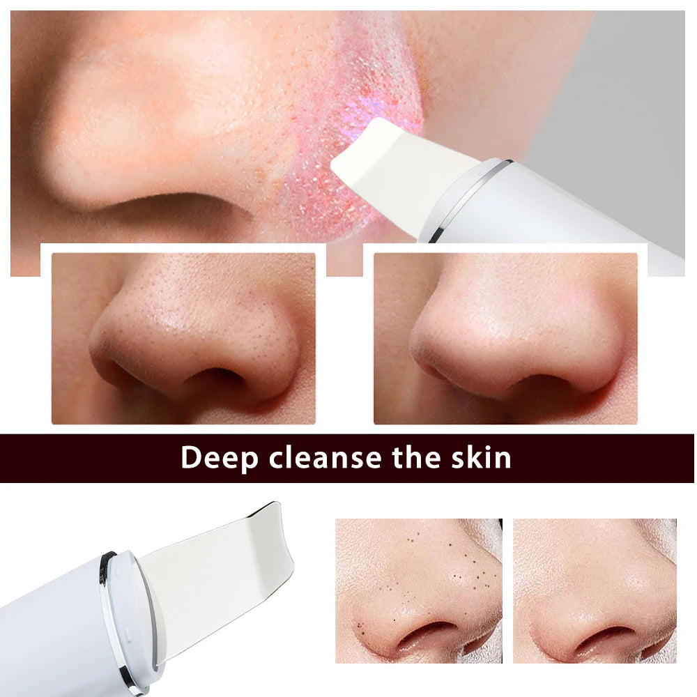 Ultrasonic Facial Skin Scrubber and Pore Cleaner