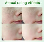 Salicylic Acid Pore Refining Cream for Acne and Blackheads