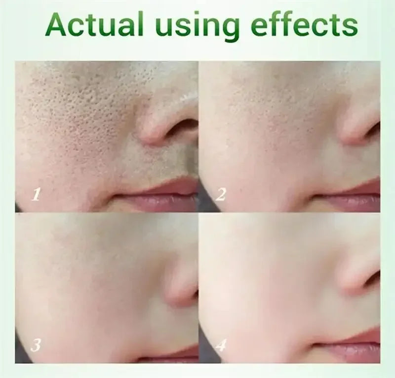 Salicylic Acid Pore Refining Cream for Acne and Blackheads