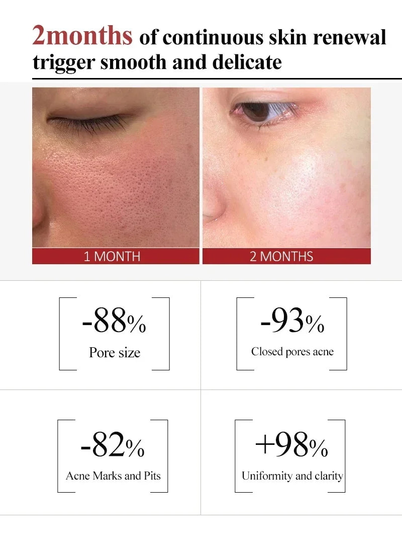 Salicylic Acid Pore Refining Cream for Acne and Blackheads - 14