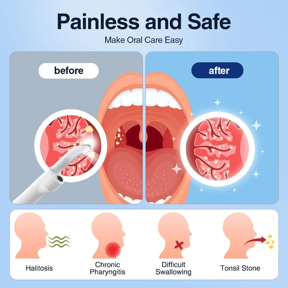HD Visible Tonsil Stone Removal Vacuum with Camera