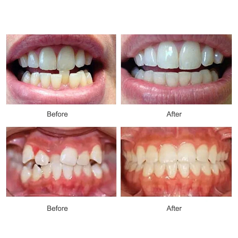3-Stage Adult Teeth Straightening Trainer Orthodontic Mouthpiece - 6