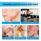 Hypochlorous Acid Facial Spray for Acne and Sensitive Skin