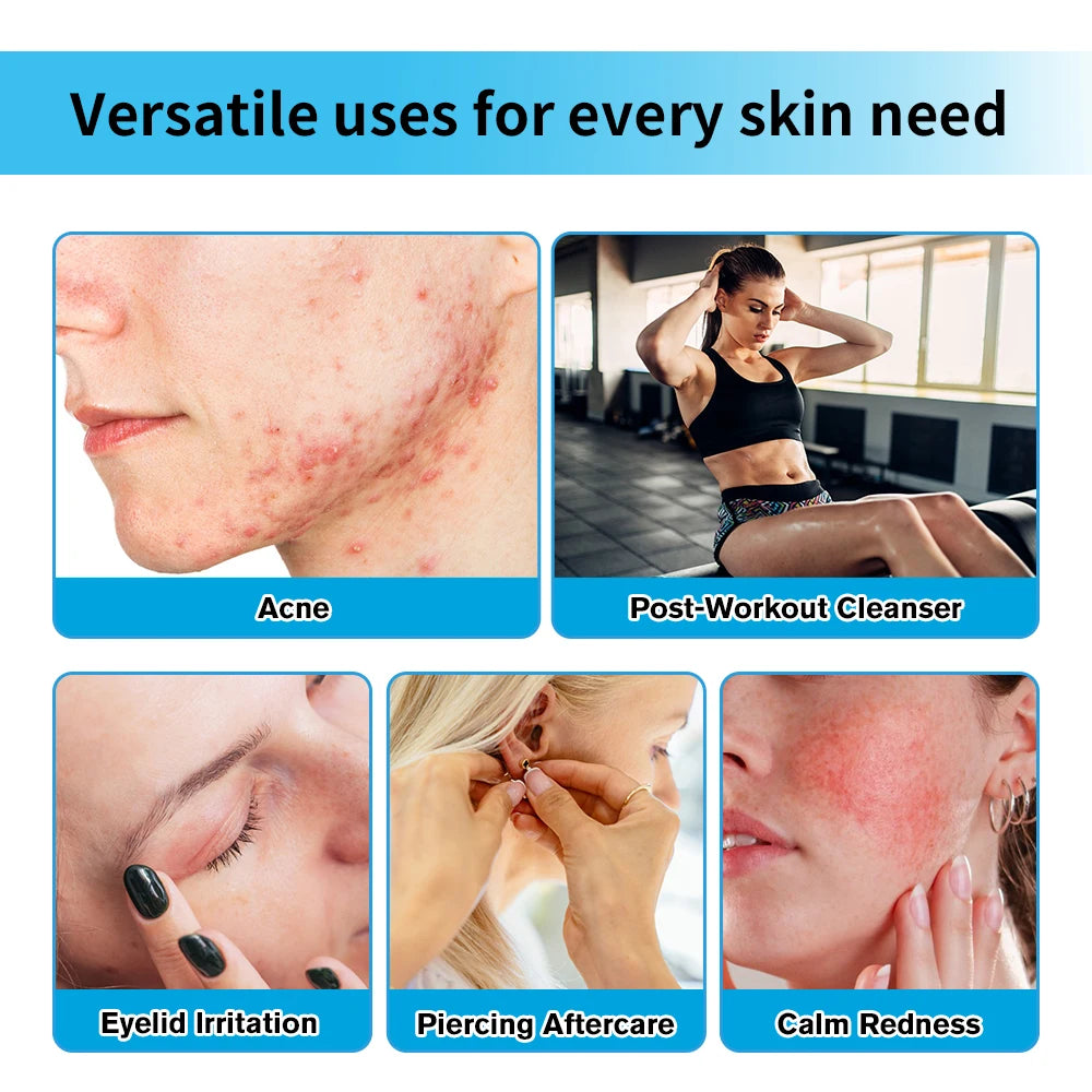 Hypochlorous Acid Facial Spray for Acne and Redness Relief - 3